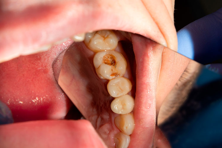 caries dental