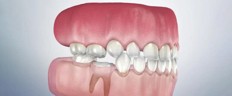 anquilosis dental