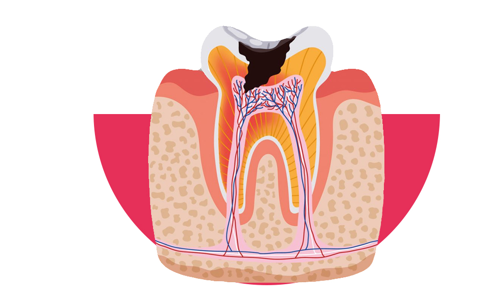 imagen de diente por dentro mostrando la pulpa dental