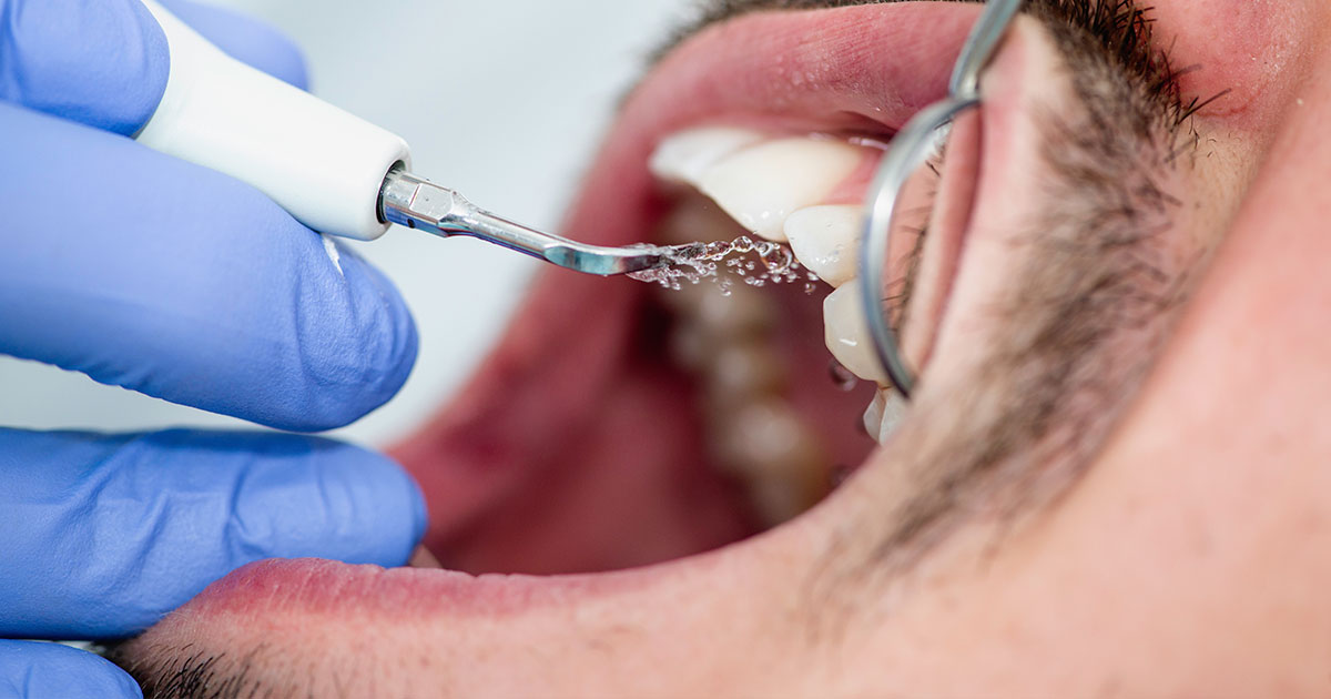 curetaje dental en DAIMIEL