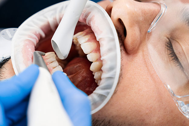 curetaje dental en daimiel